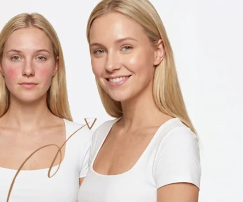 IPL-фотоомоложение